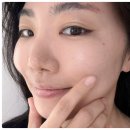 청담맑은의원 | 청담 모공축소 아토스레이저 효과 후기