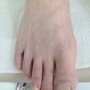 늘봄메디컬의원 | 남편 내성발톱 치료하러갔다가 발톱무좀도 박멸하고 온썰 365늘봄메디컬의원 강추해요