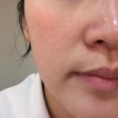 컴사바 | 부산 서면 스킨보톡스+물광주사+필로드 | 내돈내산 2주 솔직후기