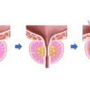 전립선의 비대 : 소변이 찔끔거리고 잔뇨감이 있을 때(남성) 이미지