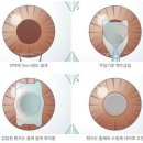 안내 렌즈 삽입술을 받은 눈 이미지