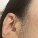 파인드피부과 | 대구반월당피부과 패인 흉터제거 전문! 오랜 흉터 치료 시작 후기
