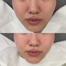 수원 인계동피부관리 겨울철 여드름, 수분 관리 후기 | 스마일뷰티