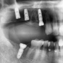 평촌이생각치과의원 | 평촌임플란트, 통증관리까지 걱정없이