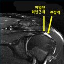 어깨회전근파열과 어깨충돌증후군의 차이점에 대해서 알아봅니다!! 이미지