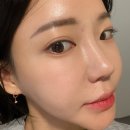 세스킨주 | 광명피부과 리쥬란힐러 2cc 쥬베룩스킨 효과 전후 통증 가격 후기