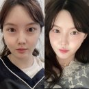 프라임빌딩 | 압구정 피부과 울쎄라 프라임 200샷 내돈내산 후기