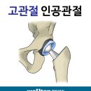고관절인공관절 재치환술 (Revision Total Hip Replacement) :: 인공관절치환술 재수술 원인 및 사례 이미지