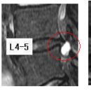 텐텐 님의 허리디스크 L4-5의 수술후 MRI 판독입니다. 이미지