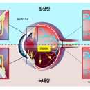 Re: 녹내장 검사법 이미지