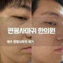 뿌리큰한의원 | 제주 피부과 추천 편평사마귀 한의원에서 없애준 후기