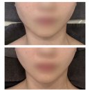 [해운대 에스테틱] 비대칭 고민 해결! 마린시티 에스테티아 해운대윤곽관리 후기 (첫방문 할인 팁)