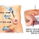 장루 복원술[Stomy repair] 이미지