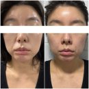 해듦한의원 | [웨딩 예신관리] 내돈내산 팔자주름 귀족침 시술 솔직 후기 및 관리방법