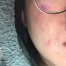 한의본가한의원 | 강남 여드름 치료 한의원 강남점에서 상담 치료받은 찐 후기 1회차