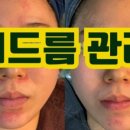 오닉스스킨테라피 이미지