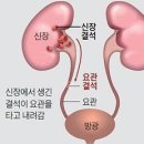 여름에 환자 껑충… &#39;요관·신장 결석&#39; 주의 이미지