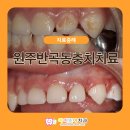 UR(원주시)-[입춘로]-하-2 | 원주반곡동충치치료 미루지 말고 적절한 시기에