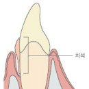 치석[dental calculus] 이미지