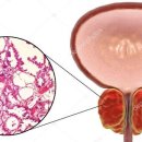 전립선 비대증과 전립선암 이미지