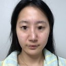 주식회사 다온다옴 | 내돈내산 청주 온다 리프팅,리쥬란,슈링크 시술 후기 효과는?