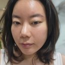 멍멍하니? | 노원피부과 엑소비스 물광피부 스킨부스터 탑티어!