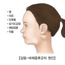 길랑바레증후군 이미지