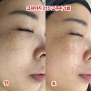 수색-015 | [상암 탄력·윤곽관리] 정서현에스테틱 - 크레이지 015 고주파로 얼굴축소 성공?! 후기