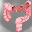 대장암 초기증상 원인.예방법 이미지