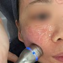 이치로 | 강남피부과추천 엑소샤넬스킨부스터2cc 통증없이 리에이치로 받은후기