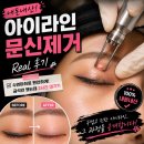 미인유성형외과의원 | 내돈내산 아이라인 문신 제거 후기 | 붓기, 멍, 딱지 변화 총정리 (1~5일차)