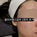 알파강남 | 울트라펄스알파 한달반 경과 후기, 그리고 2회차 여드름흉터 치료 시작