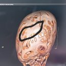 원당2통 | 두개골 조기유합증 후기2