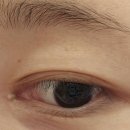 해맑은피부과의원 | 번동 해맑은의원 피부과 눈 앞머리 눈물샘 앞트임 비립종 피지 제거 후기