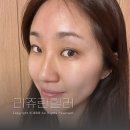 일산역 갤러리 피부과 스킨부스터 리쥬란힐러 이마 2cc 변화 후기 잔주름개선 만족