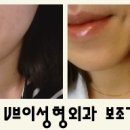 보조개수술 한쪽 비용은? 대구성형외과 보조개성형 전후사진 첨부 이미지