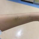 209.서울병원_2 | 서울여성병원 제왕절개 2일차 후기(빈혈검사/수액제거/모유수유 시작)