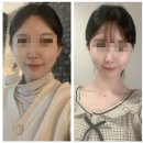성북 성신여대 한의원:) 내돈내산 규장한의원 정안침 매선 비대칭교정 효과 후기