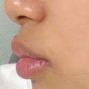 웃는바른이치과교정과치과의원 | 이수 웃는 바른이 교정치과 2년 교정 끝! 비용/발치/비추? 솔직후기