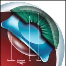 [봄의약속안과] 라식/라섹이 안되면? 안내렌즈삽입술[ICL] (강동 안내렌즈 ICL) 이미지