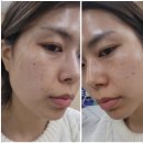 (주)스페이스프로 제2공장 | 역삼 기미잡티제거] 미작뷰티 클리어 스팟 프로 4-5회차 리얼 후기, 드디어 빛을 보는 피부! ✨#솔직후기