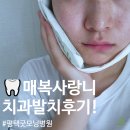 샘정문약국 | [내돈내산] 평택 굿모닝병원 치과 매복사랑니 발치 비용 붓기 식사 주의사항 등 자세한 후기!!
