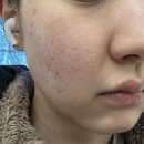 하오덤의원 | 압구정 피부과 진정관리 받아본 솔직 후기! (산소테라피, LDM) 피부 케어 추천 내돈내산