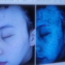 경주사 | 광대주사 후 압출했다가 피부 뒤집힘 | 병원 소통 문제 있었던 과정