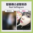 탑클래스성형외과의원 네이버블로그