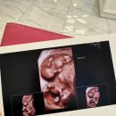 황바니 | 쌍둥이 임신12주｜1차 기형아검사 후기, 임신초기증상