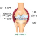 류마티스 관절염과 퇴행성 관절염은 무엇이 다른가요? 이미지