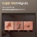 [색소침착,기미치료] 어버이날선물 메디테라피 화이트 토닝 이용 후기