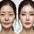 분당 리프팅 관리,팔자 주름과 볼살 처짐 , 30대부터 시작해야 하는 이유