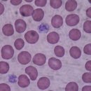 건강정보③ - 혈액, 혈액형의 개념, 혈액과 관련된 질병, 이미지